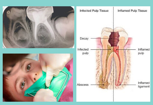 Pediatric pulp therapy and root canal treatment