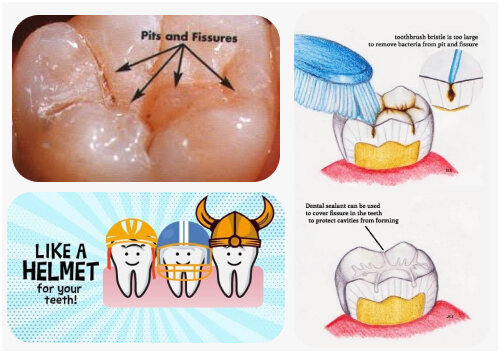 Dental sealants for cavity prevention