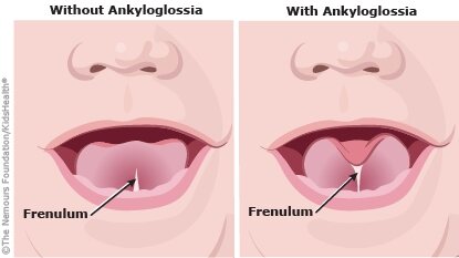 Tongue tie assessment and treatment